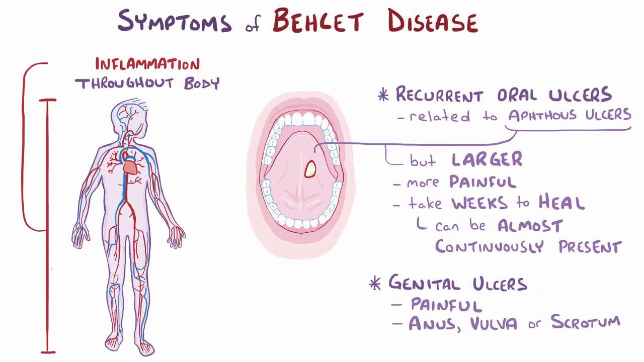 How To Diagnose Behcet S How To Diagnose Beh et s And Intestinal 