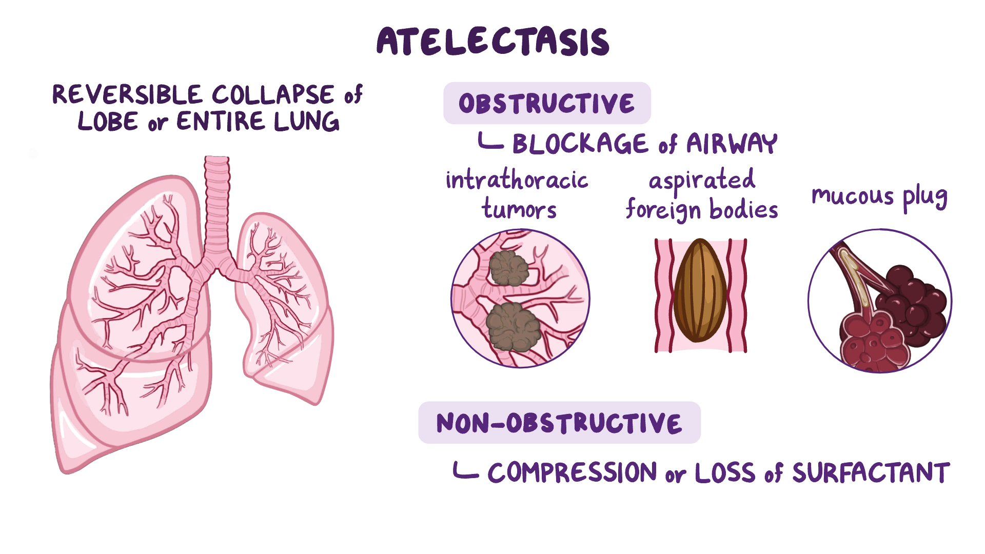 Atelectasis Causes Symptoms Diagnosis Treatment 53 OFF