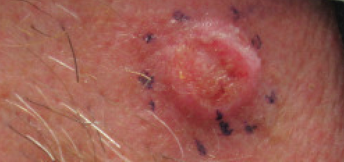 Squamous Cell Carcinoma