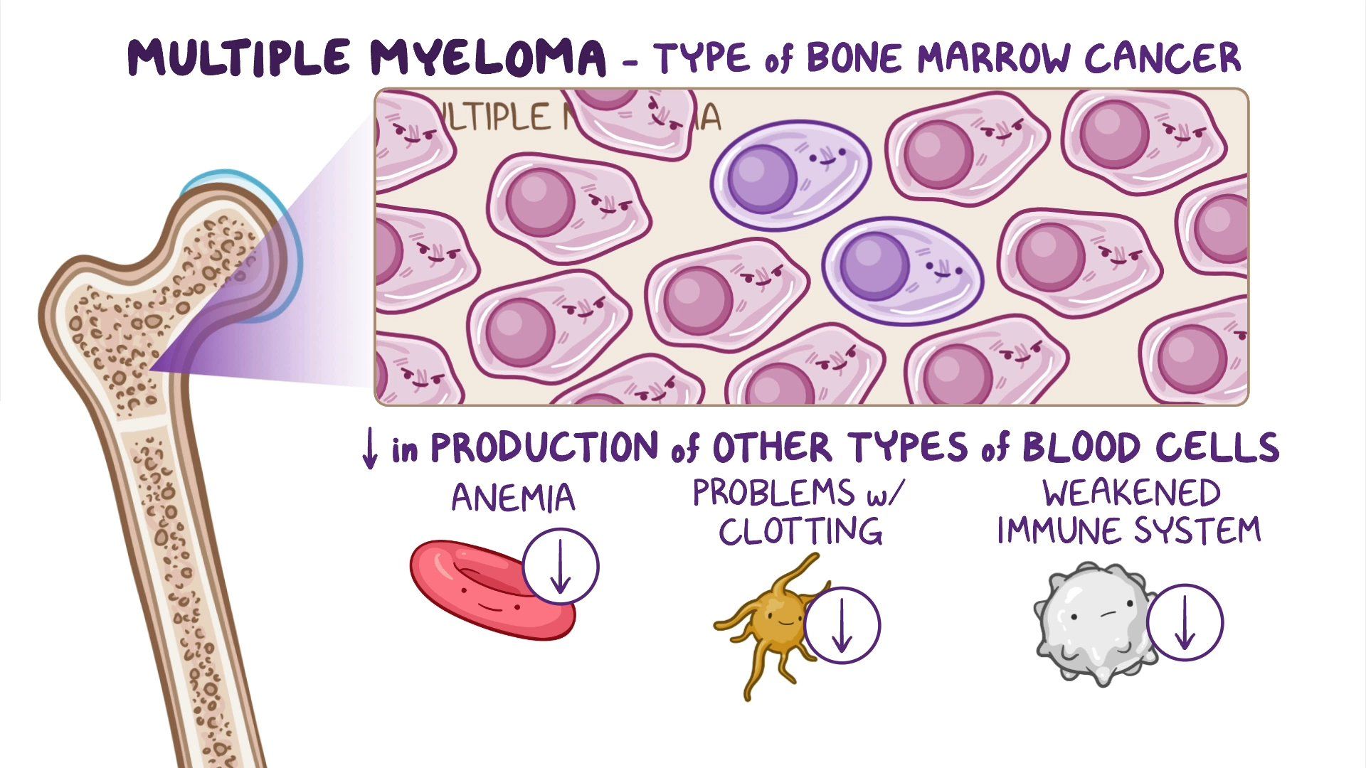 Multiple Myeloma Prognosis At Stephanie Cooke Blog