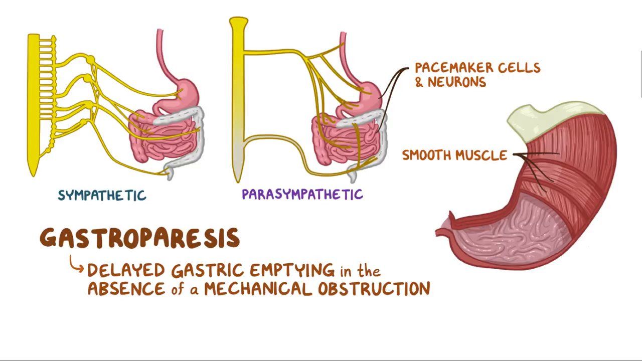 Gastroparesis Symptoms Causes Diagnosis Treatment 52 OFF Gastroparesis Symptoms Causes Diagnosis Treatment 52 OFF
