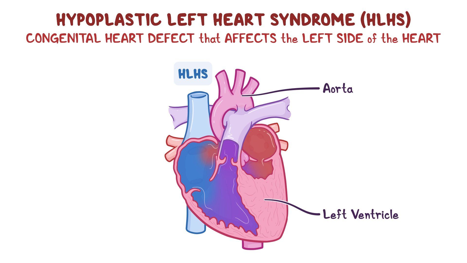 健康・医学 Hypoplastic Left Heart Syndrome Do relatives of children with hypoplastic left heart