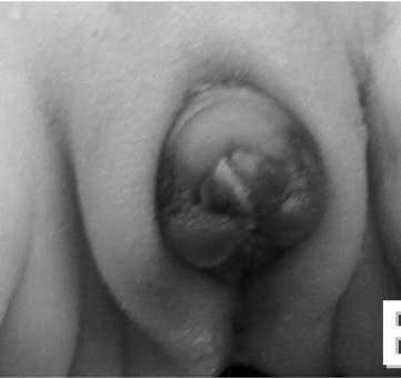 A close-up, black & white shot shows an umbilical granuloma. The raised, fleshy mass is round & red, with a darker center, appearing inflamed on a baby's navel.