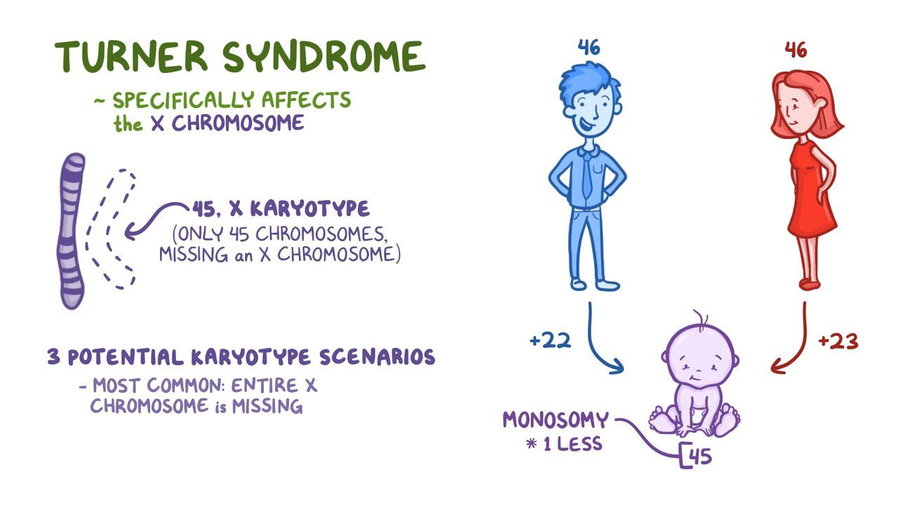 Turner s Syndrome Is Caused By A Mutation At Josephine Hernandez Blog