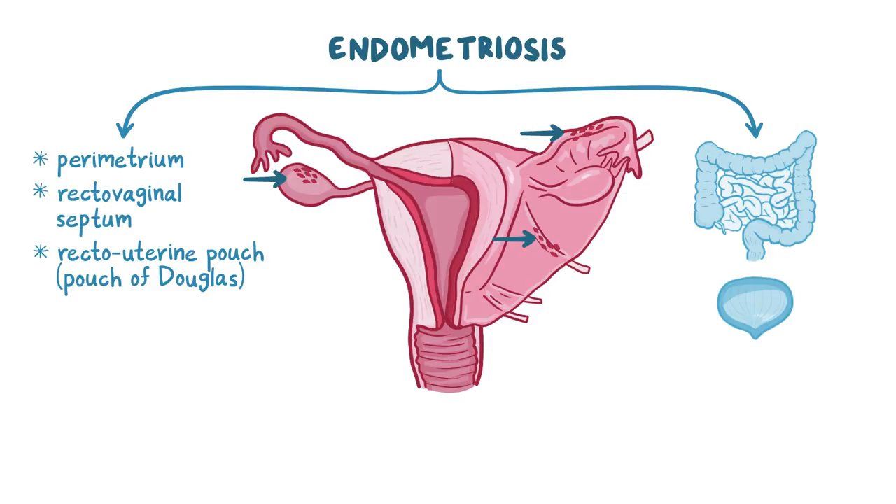 Endometriosis Video Anatomy Definition Function Osmosis