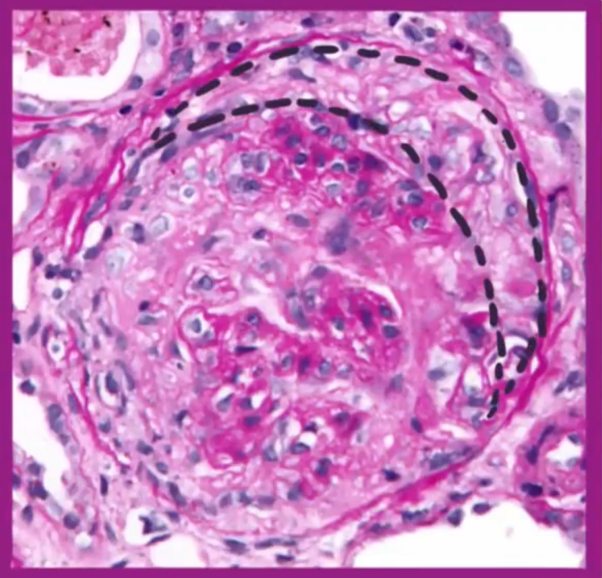 A microscopy image shows a glomerulus with a dashed line around its periphery. The glomerulus has many cells and a pink matrix.