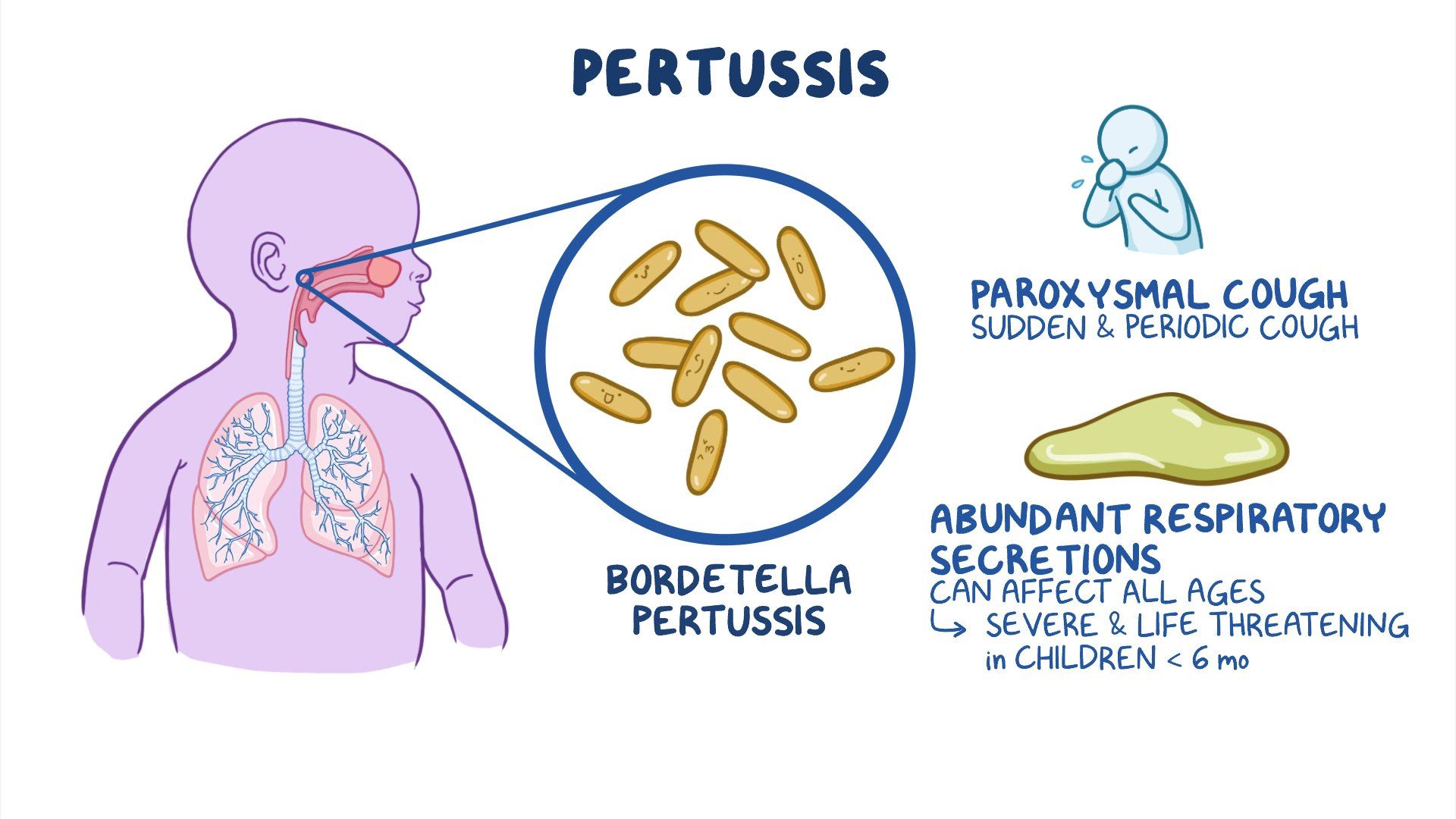 Pertussis Nursing Osmosis Video Library