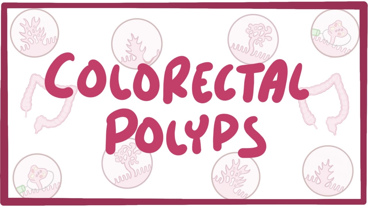 Colorectal Polyps Osmosis Video Library 