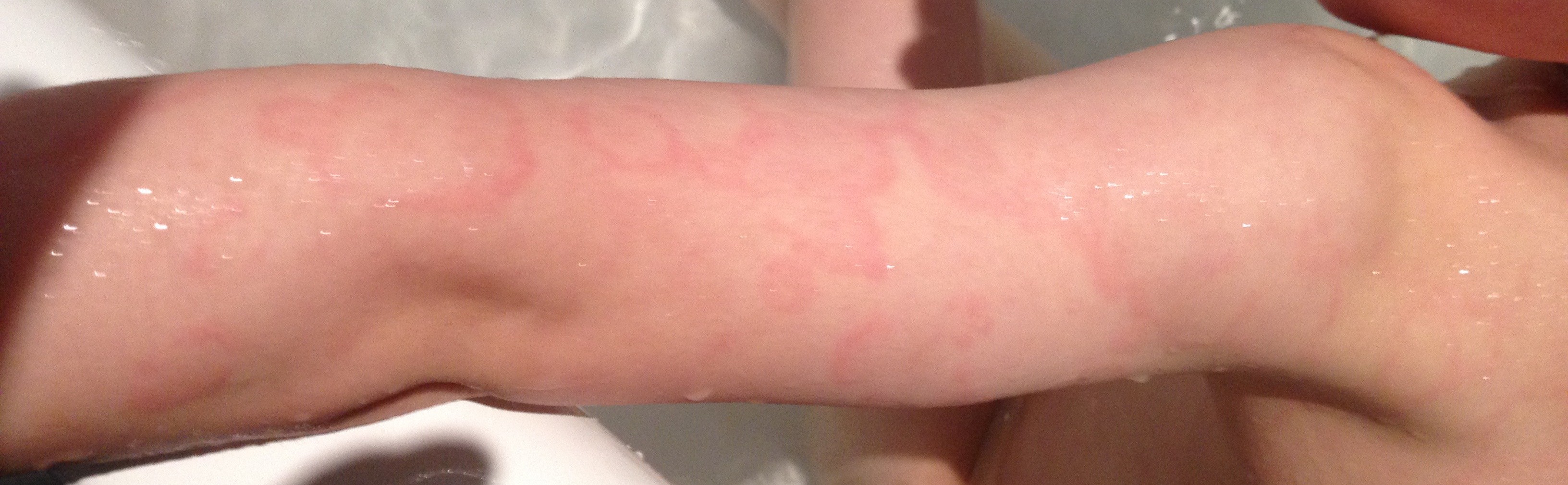 https://upload.wikimedia.org/wikipedia/commons/4/41/Erythema_marginatum.jpg?utm_source?en.wikipedia.org&utm_campaign?index&utm_content?thumbnail_unscaled