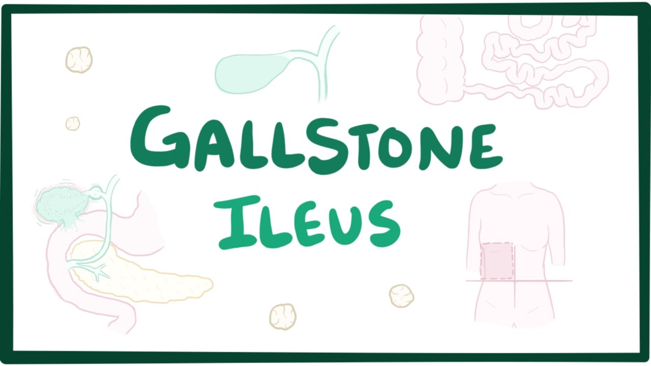 Gallstone ileus Video, Anatomy, Definition & Function Osmosis