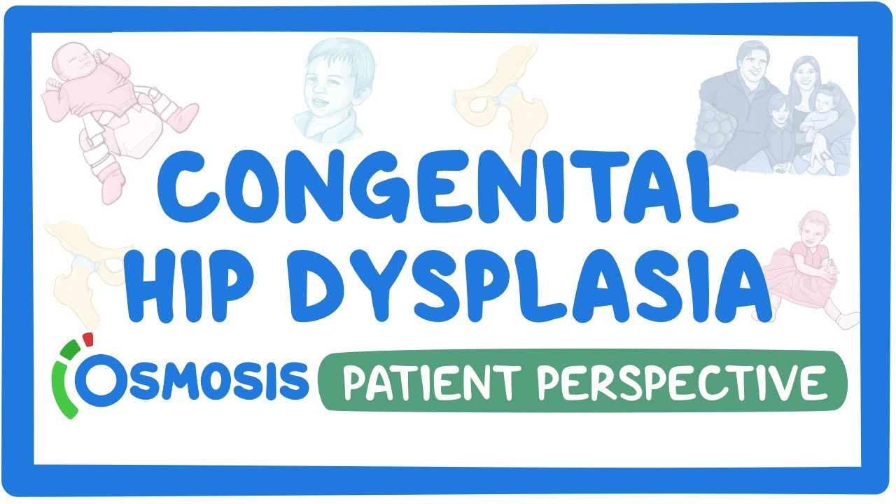 Patients Perspective Congenital Hip Dysplasia Osmosis Video Library
