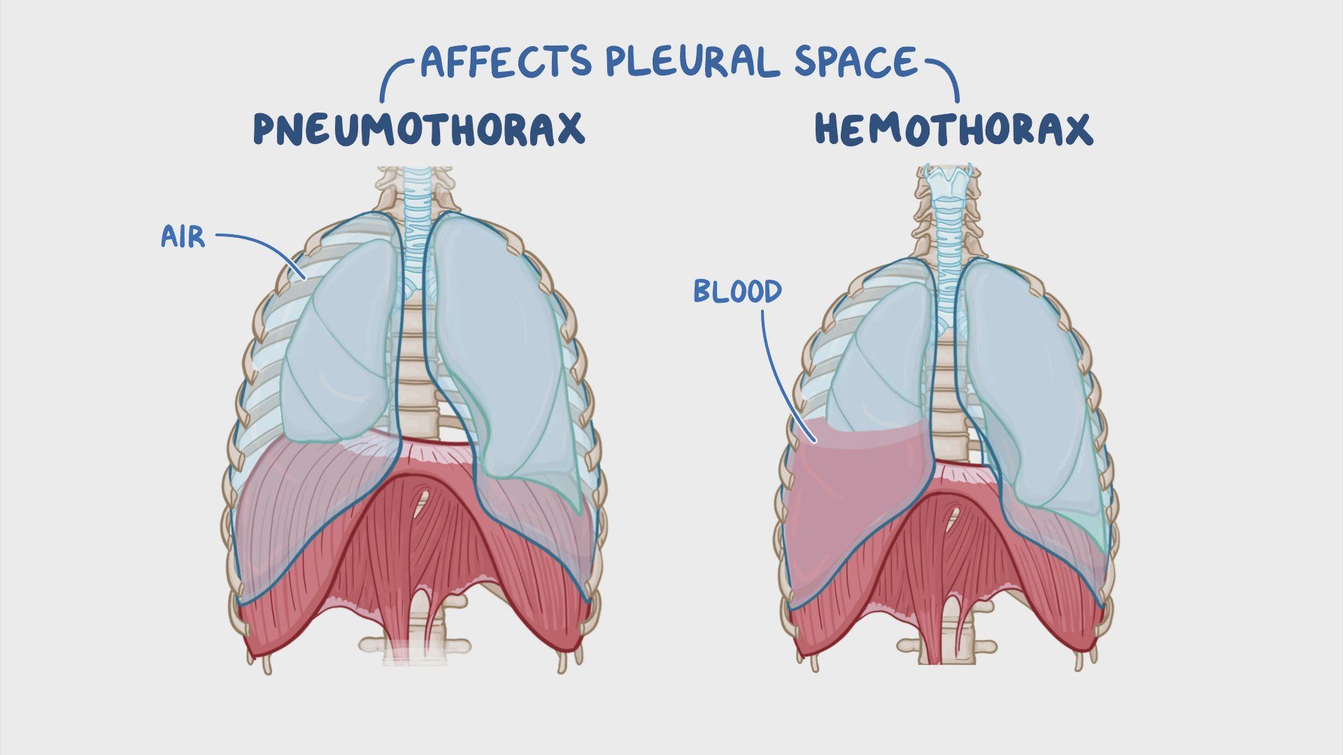 Hemothorax Vs Pneumothorax Chest X Ray At Leroy Ureno Blog Hemothorax Vs Pneumothorax Chest X Ray At Leroy Ureno Blog