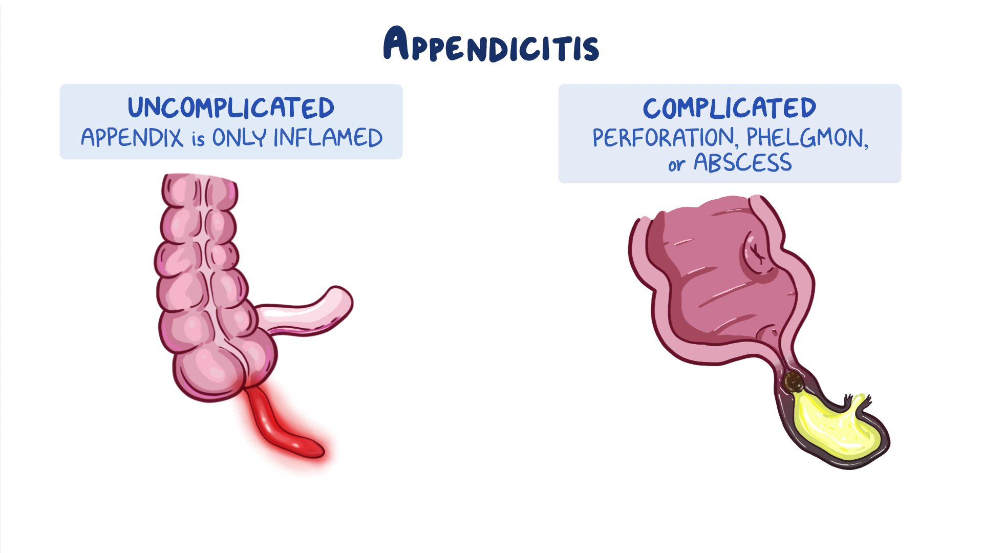 Appendicitis Clinical Sciences Osmosis Video Library Appendicitis Clinical Sciences Osmosis Video Library