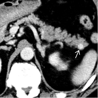 Computer tomography imaging with pancreatic protocol