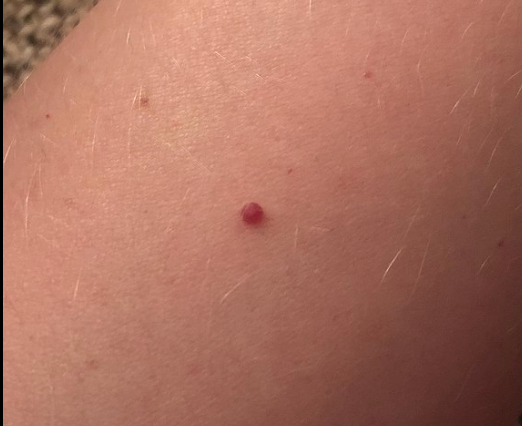 Cherry angioma