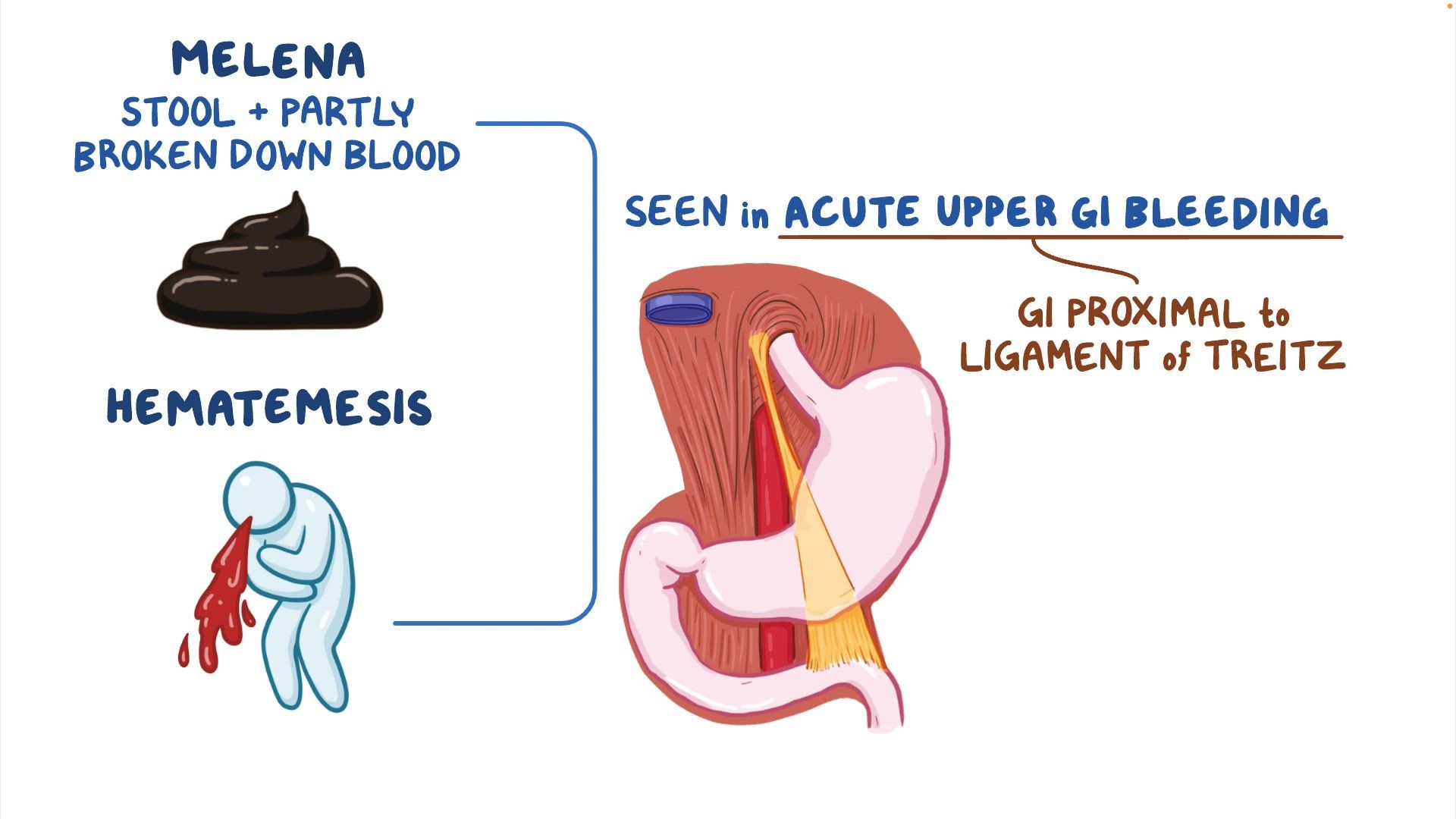 Approach To Melena And Hematemesis Clinical Sciences Osmosis Video Approach To Melena And Hematemesis Clinical Sciences Osmosis Video