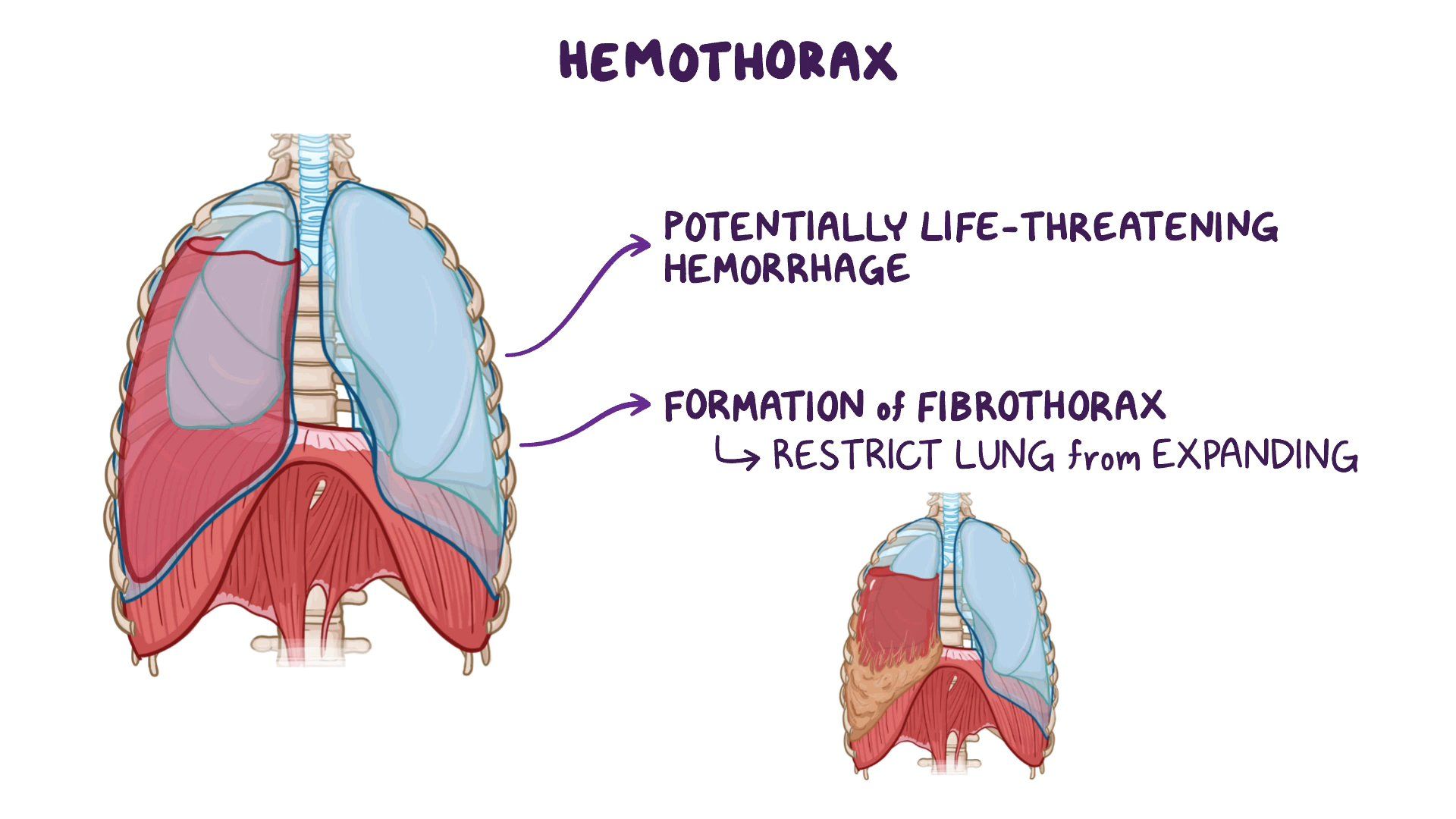 Hemothorax Empyema At Linda Fujiwara Blog Hemothorax Empyema At Linda Fujiwara Blog