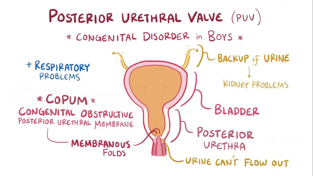 types-of-posterior-urethral-valve-design-talk