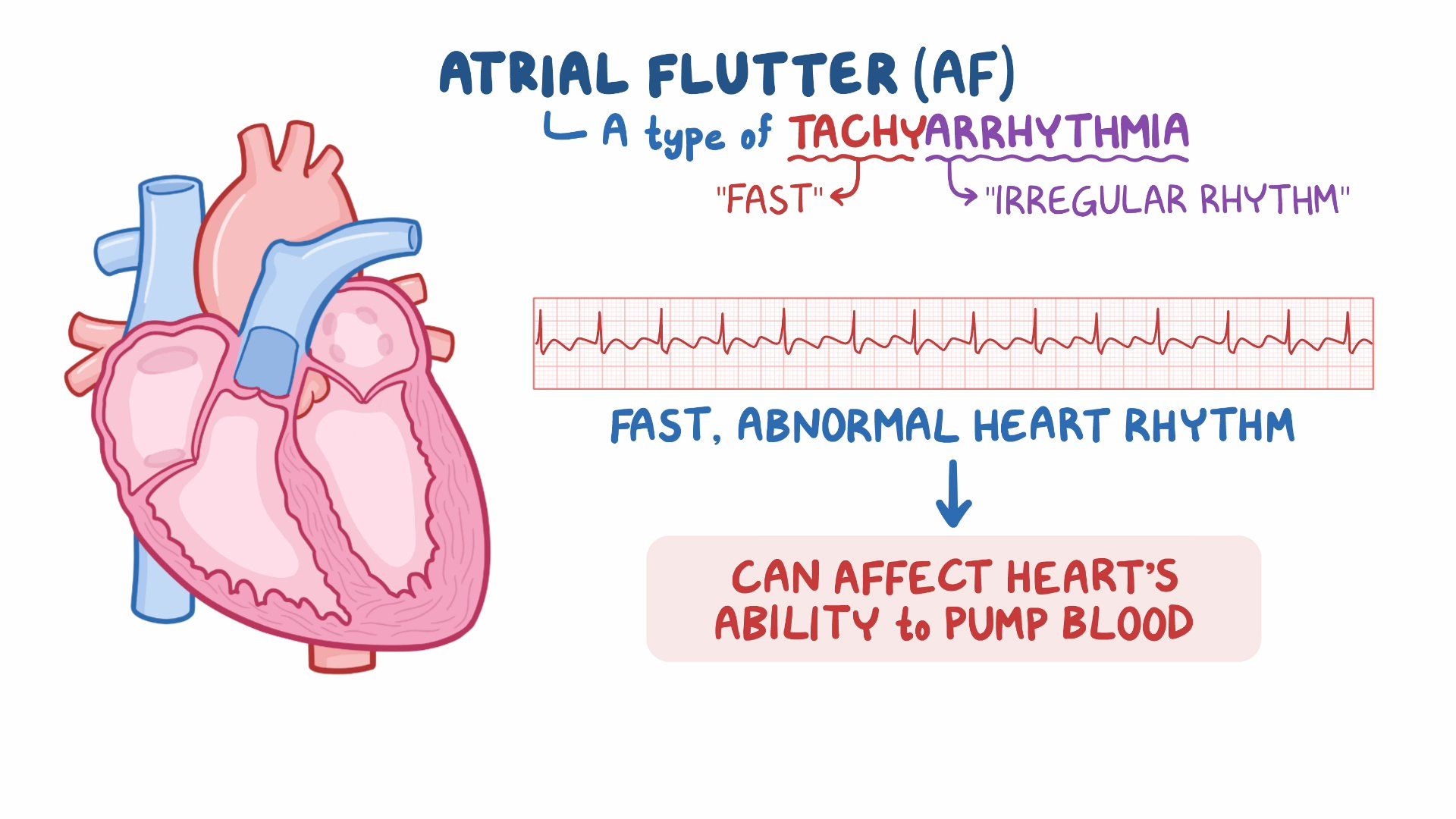 Atrial Flutter ECG Interpretation With Examples Manual 58 OFF